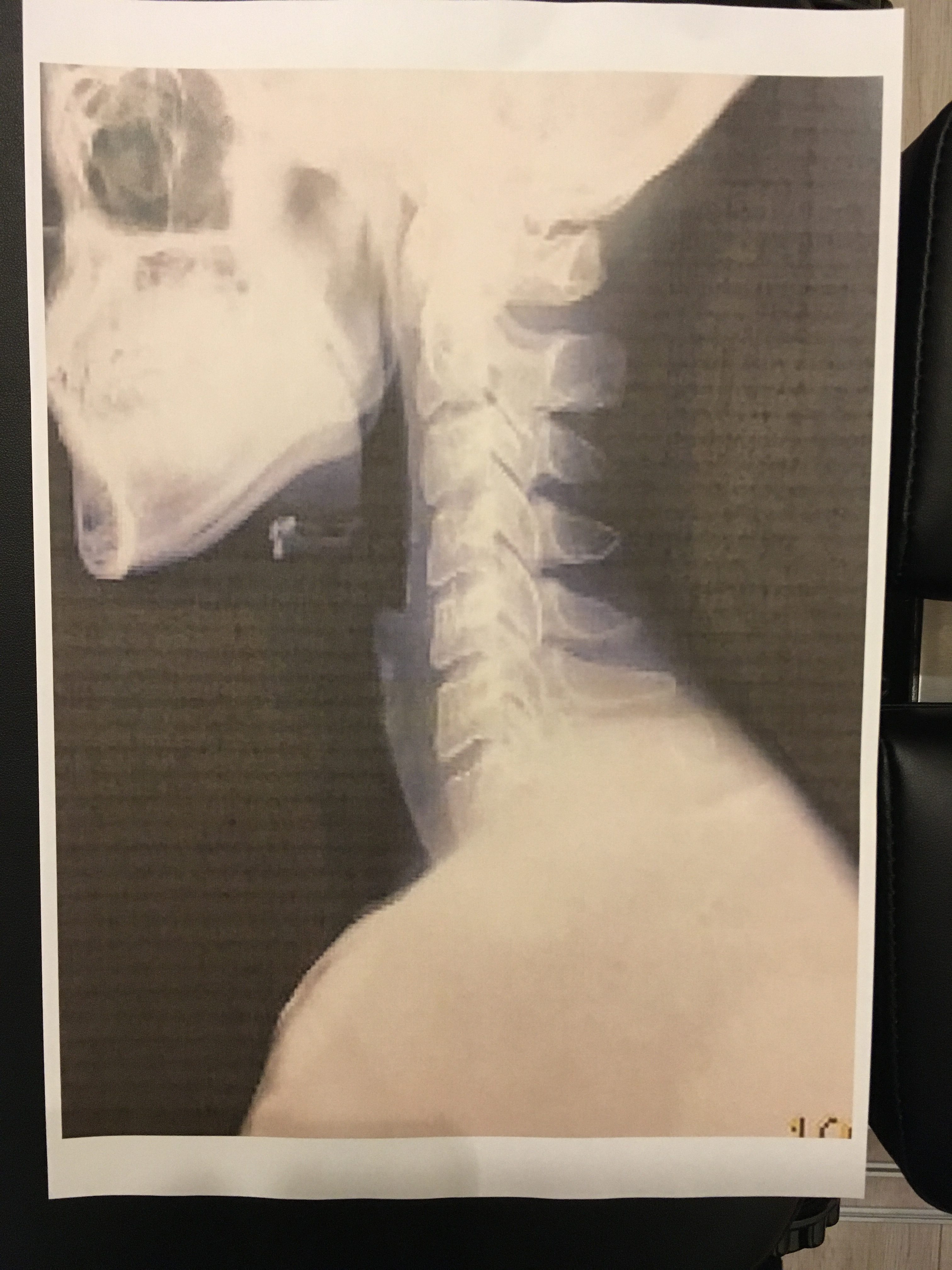 頸椎のレントゲン画像の側面像