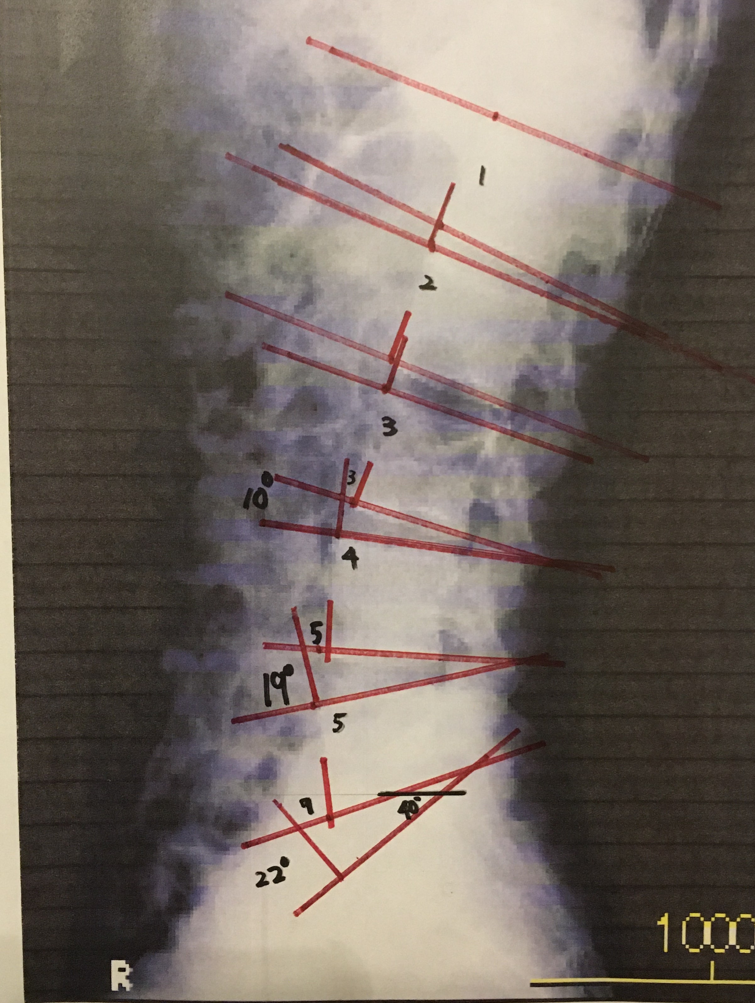 腰・骨盤のレントゲン分析後の画像