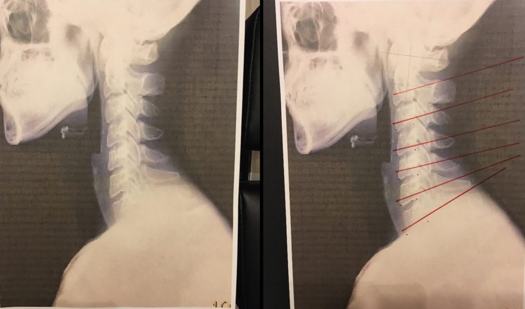 Cervical X-ray