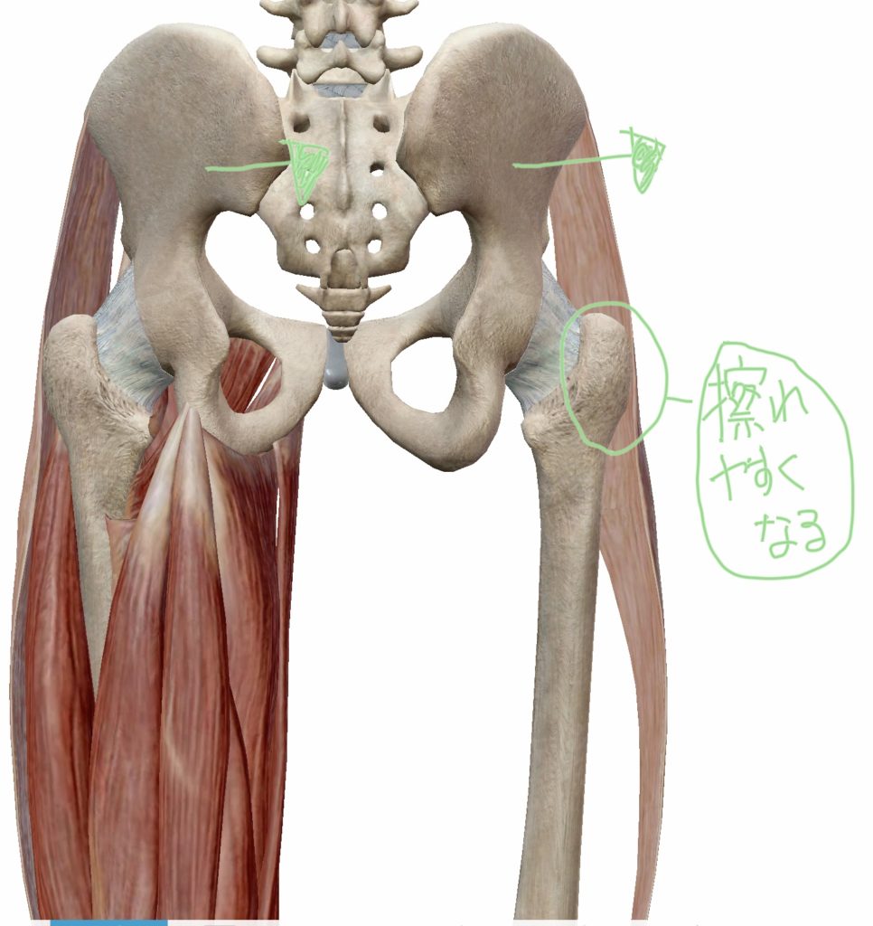 骨盤がズレた際の大腿筋膜張筋・腸脛靭帯と大転子滑液包の位置関係の図