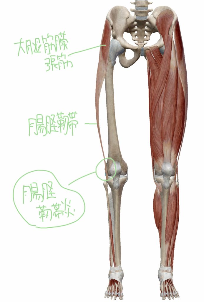 大腿筋膜張筋・腸脛靭帯と腸脛靭帯炎の位置関係の図