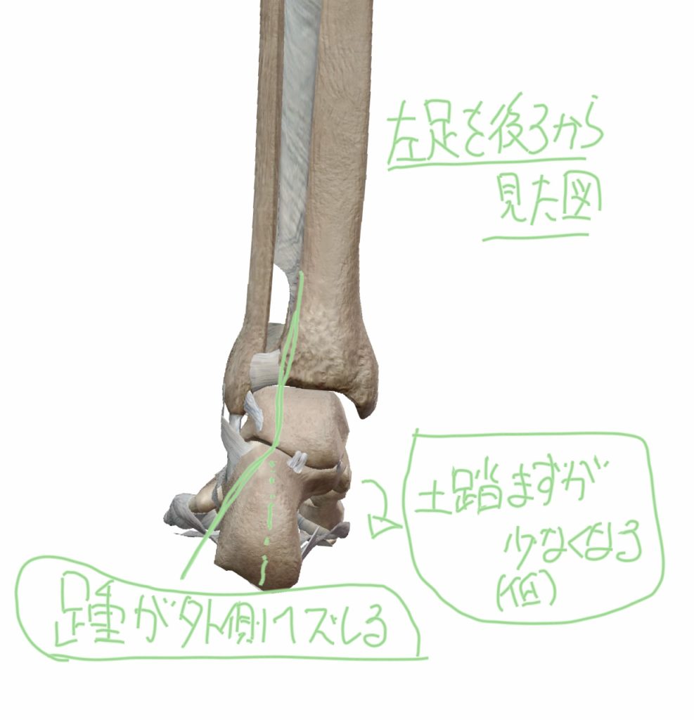 足を後方から見た距骨下関節と距腿関節の位置で距骨下関節（踵が）外側にズレている図