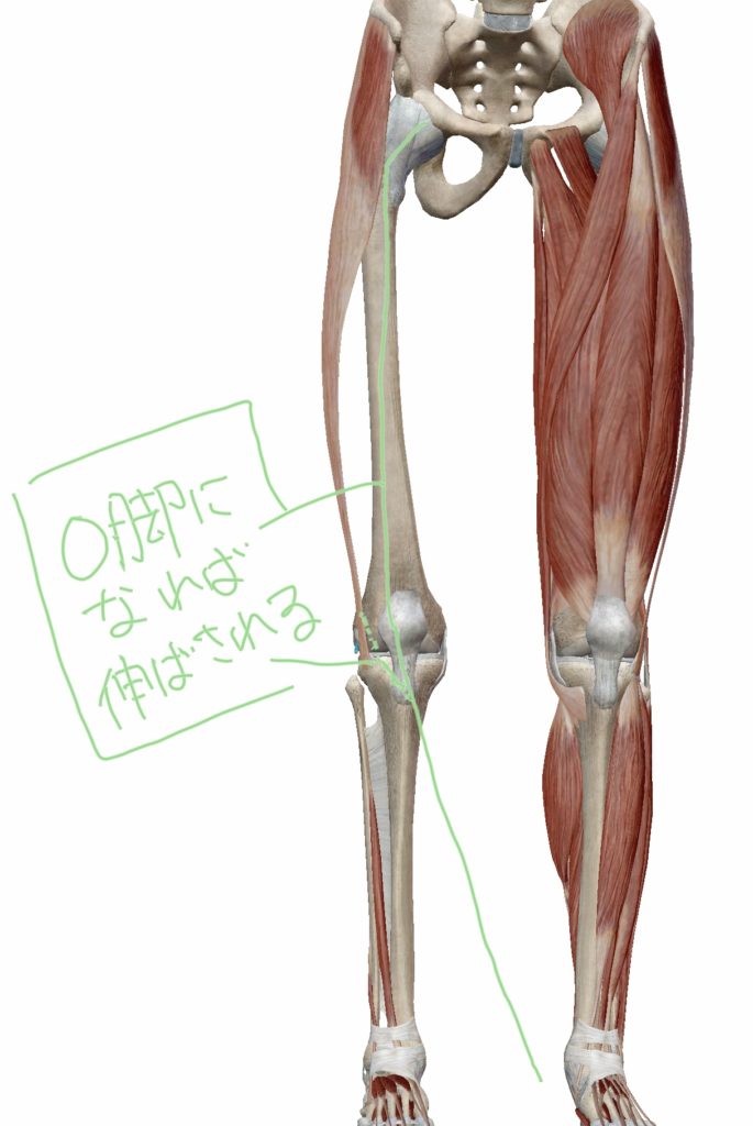 すねがズレた際の大腿筋膜張筋・腸脛靭帯と大転子滑液包の位置関係の図